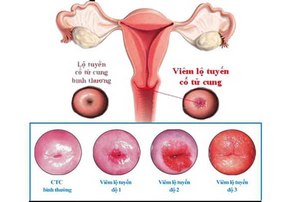 Viêm lộ tuyến cổ tử cung