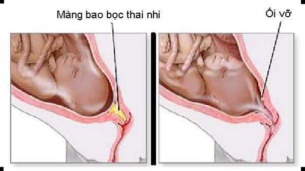 Vỡ ối trong thai kỳ